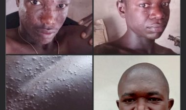 Residents Raise Alarm Over Outbreak Of Mpox Disease, As Benue Govt Active Investigation
