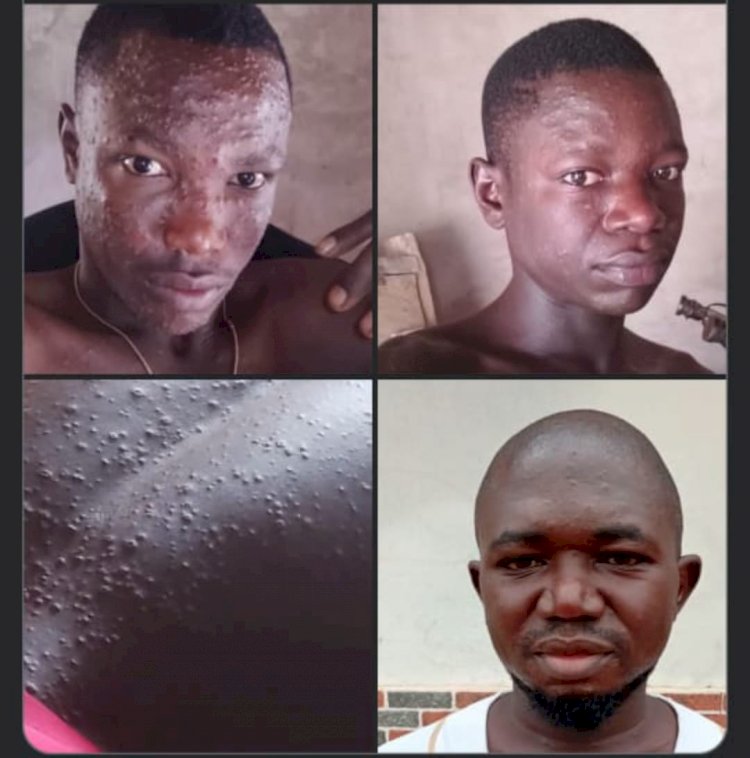 Residents Raise Alarm Over Outbreak Of Mpox Disease, As Benue Govt Active Investigation